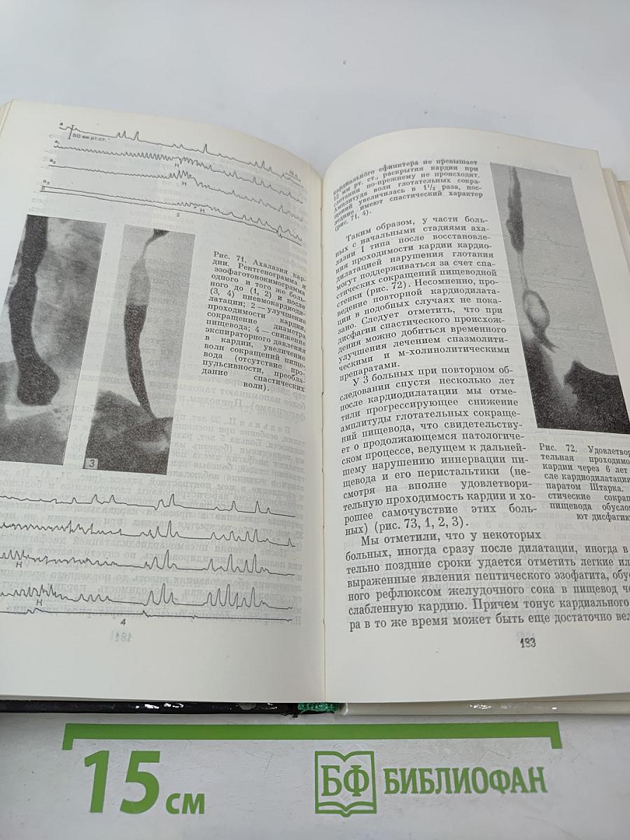 Ахалазия кардии