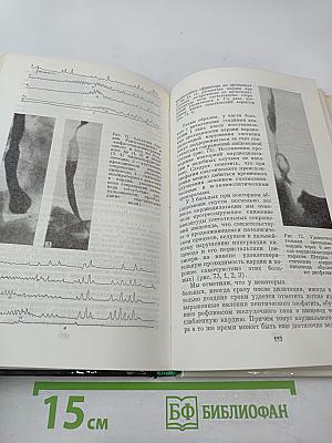 Ахалазия кардии