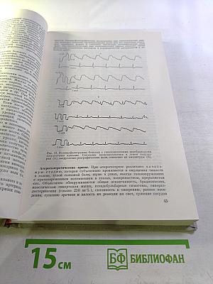 Церебральные кризы и инсульт