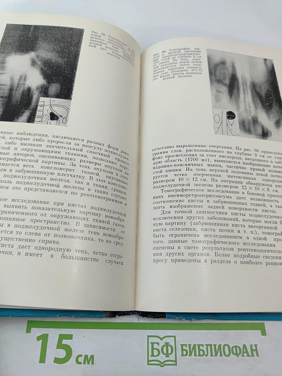 Рентгенодиагностика заболеваний поджелудочной железы (Клинико-рентгенологические наблюдения)