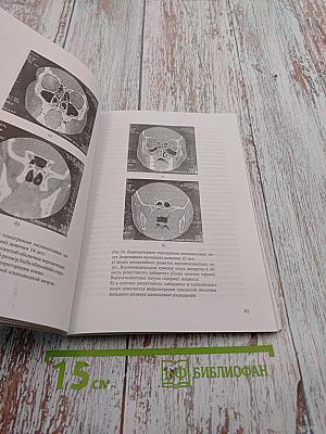 Сфеноидиты у детей