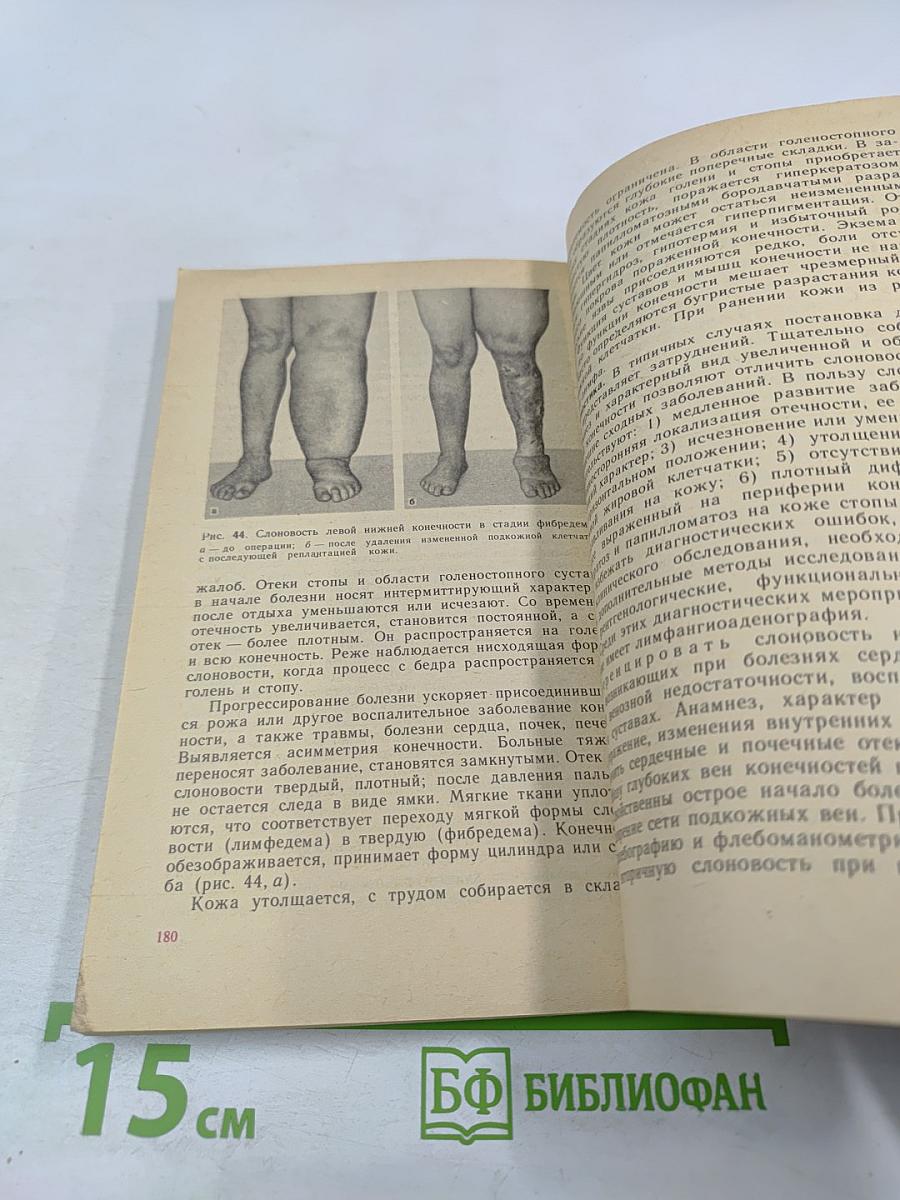 Болезни вен и лимфатической системы конечностей