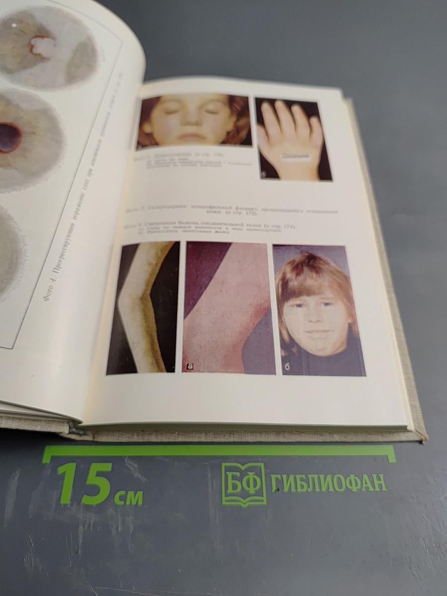 Ревматические болезни у детей