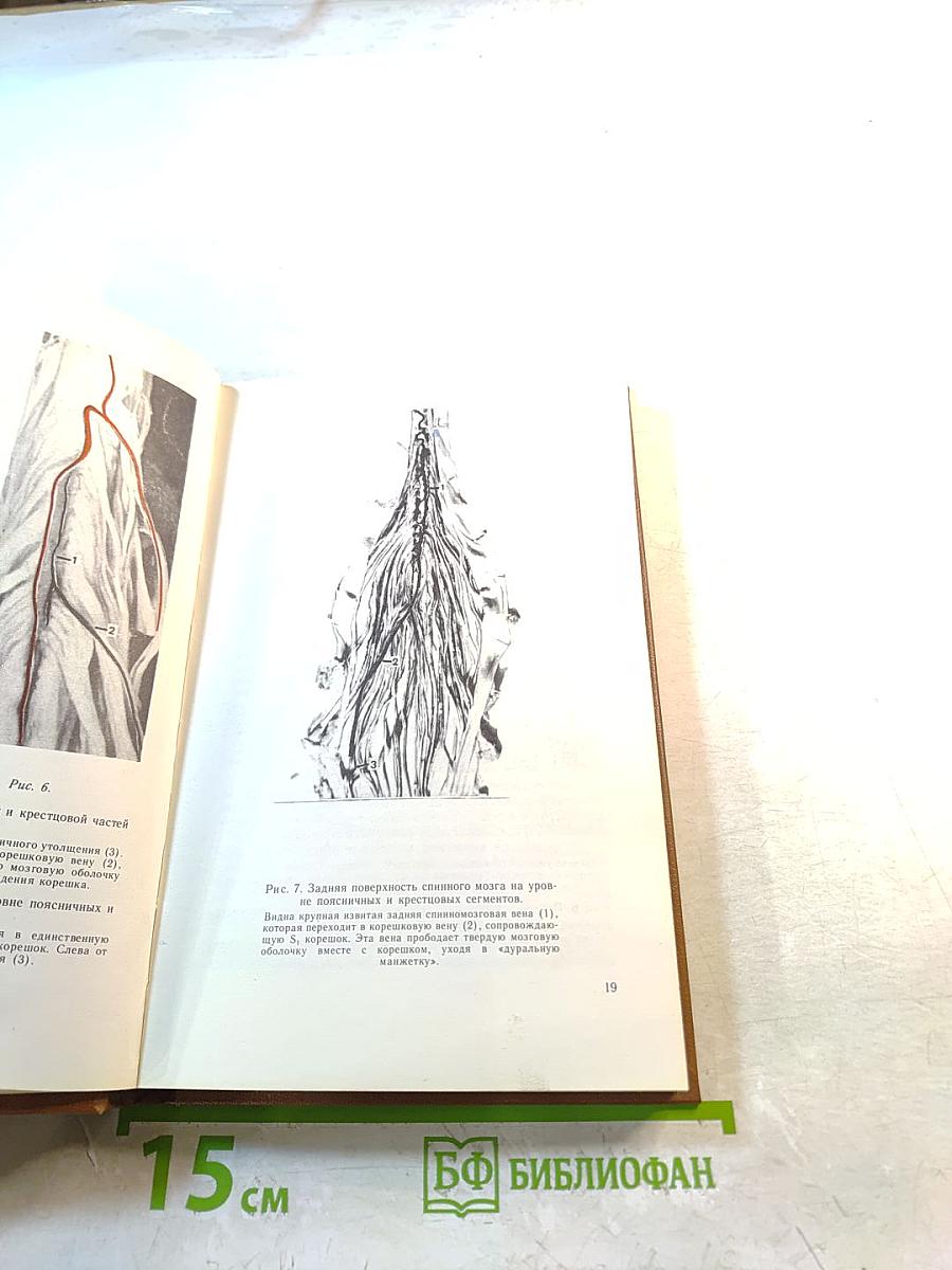 Клиника и хирургическое лечение дискогенных пояснично-крестцовых радикуломиело-ишемий