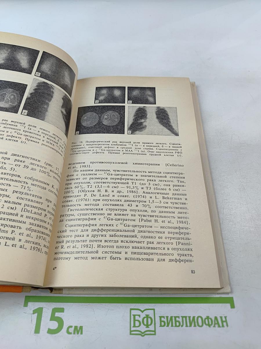 Рак легкого