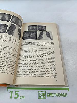 Рак легкого