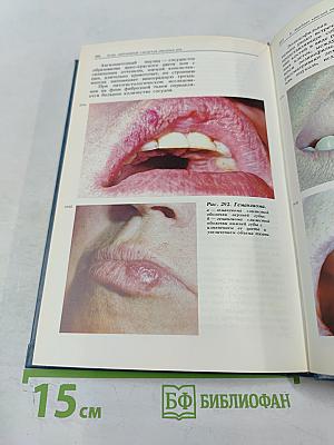 Атлас заболеваний слизистой оболочки рта