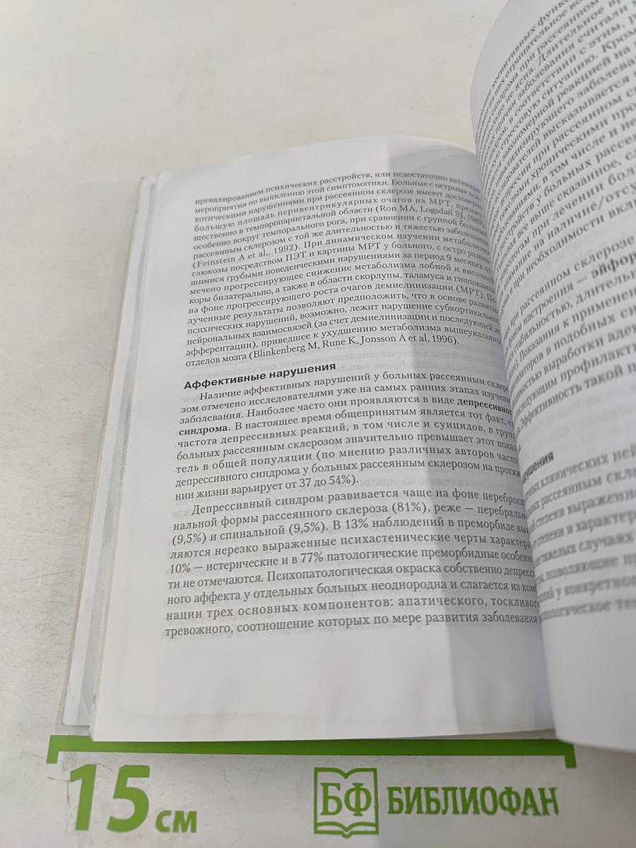 Рассеянный склероз