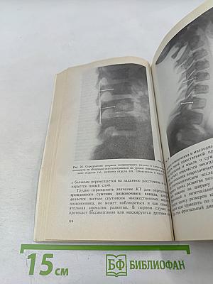 Аномалии позвоночника у детей