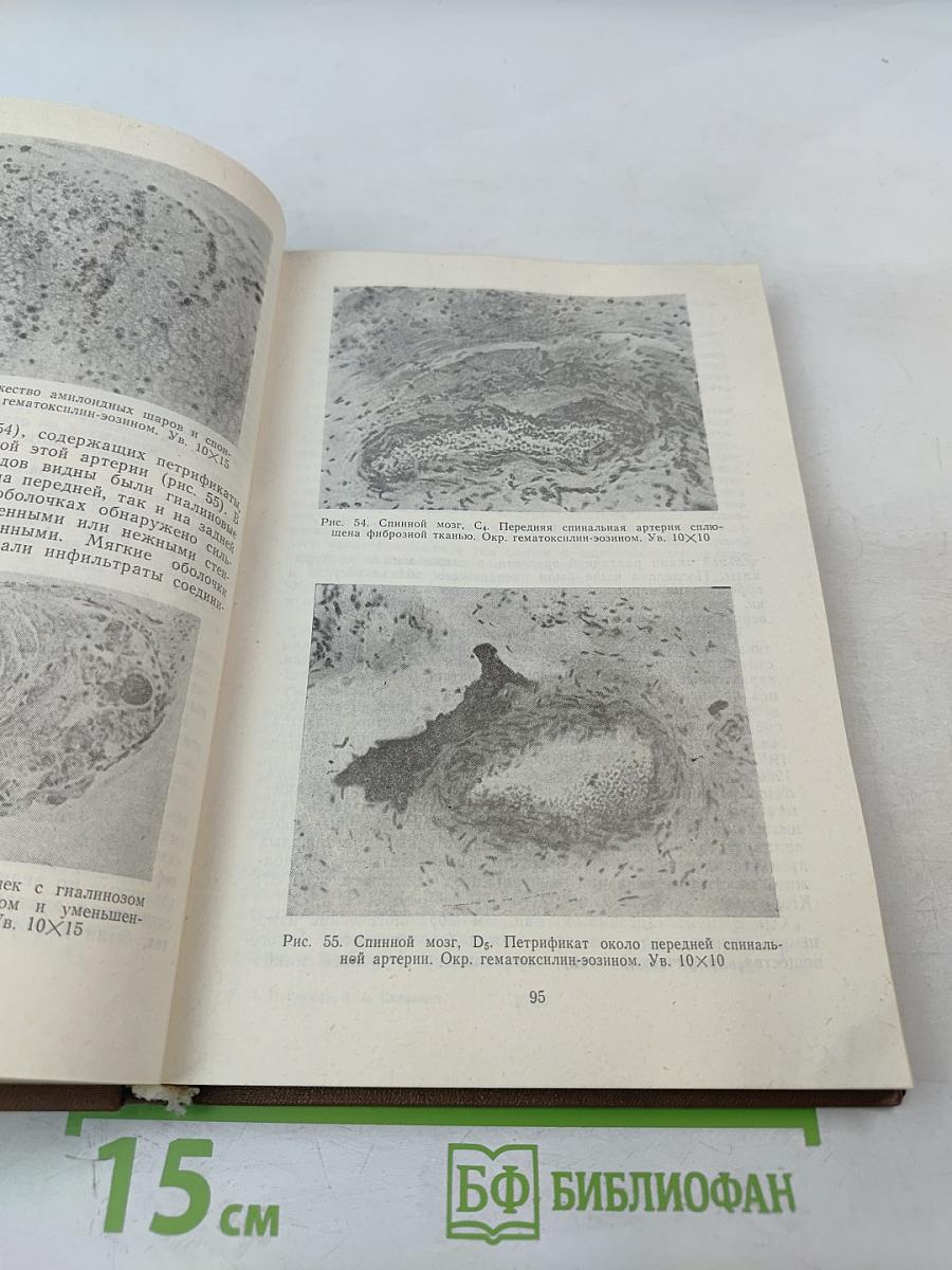 Нарушения спинномозгового кровообращения