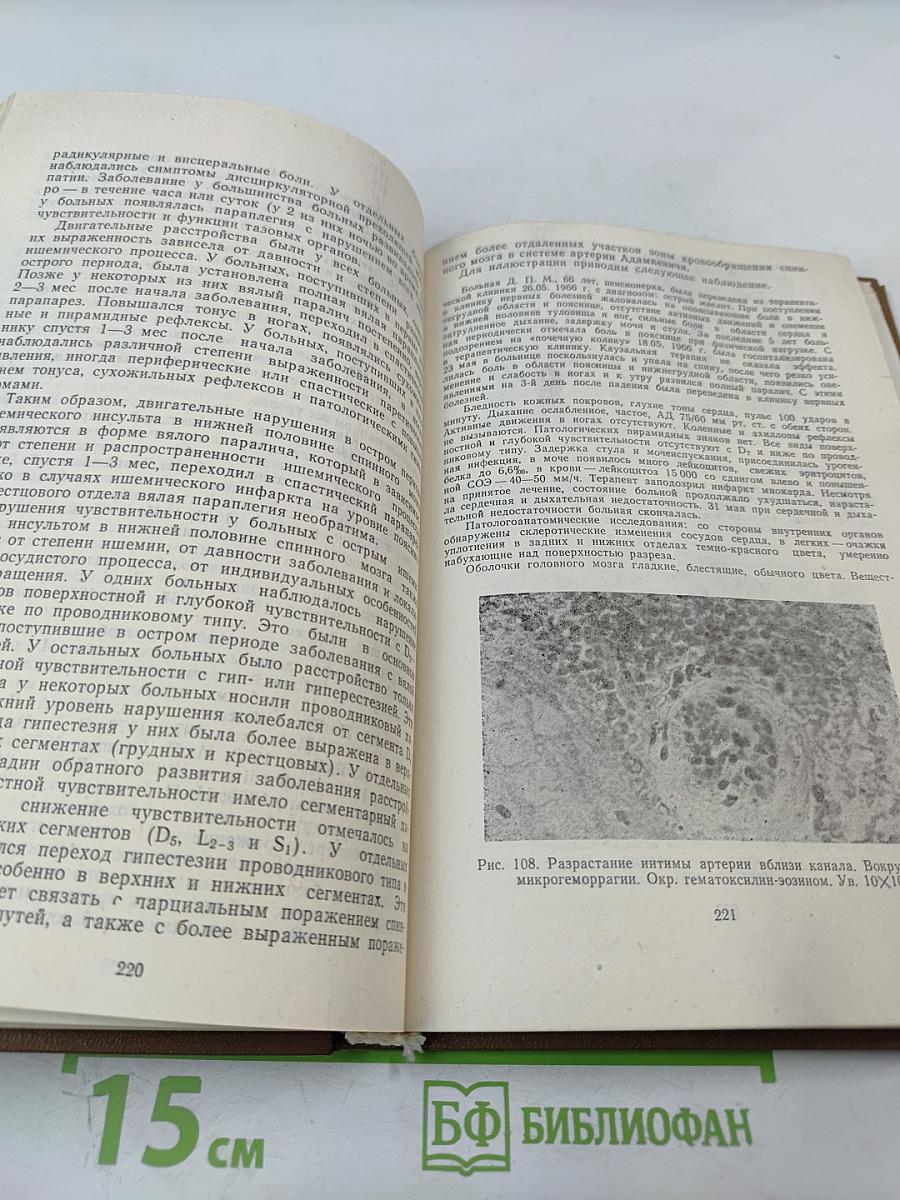 Нарушения спинномозгового кровообращения