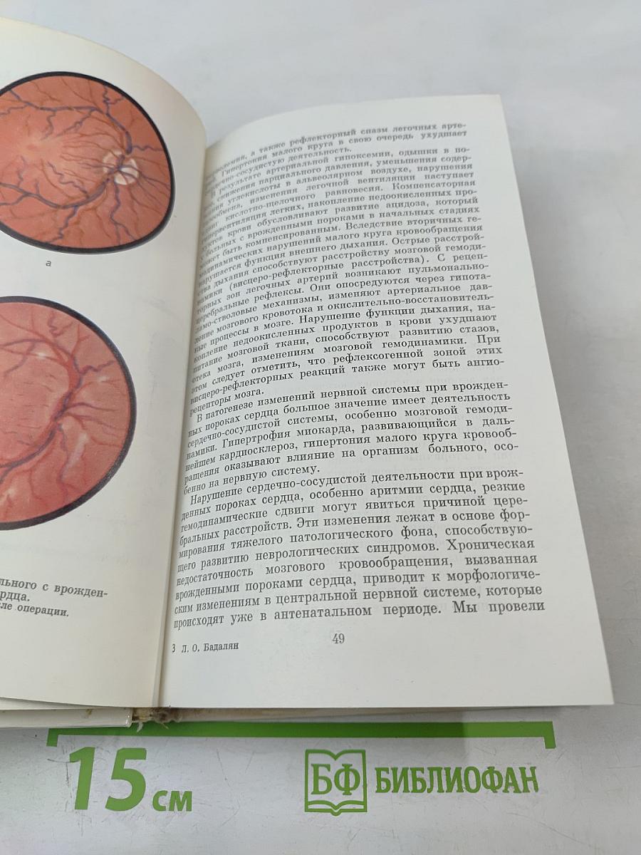 Неврологические синдромы при болезнях сердца