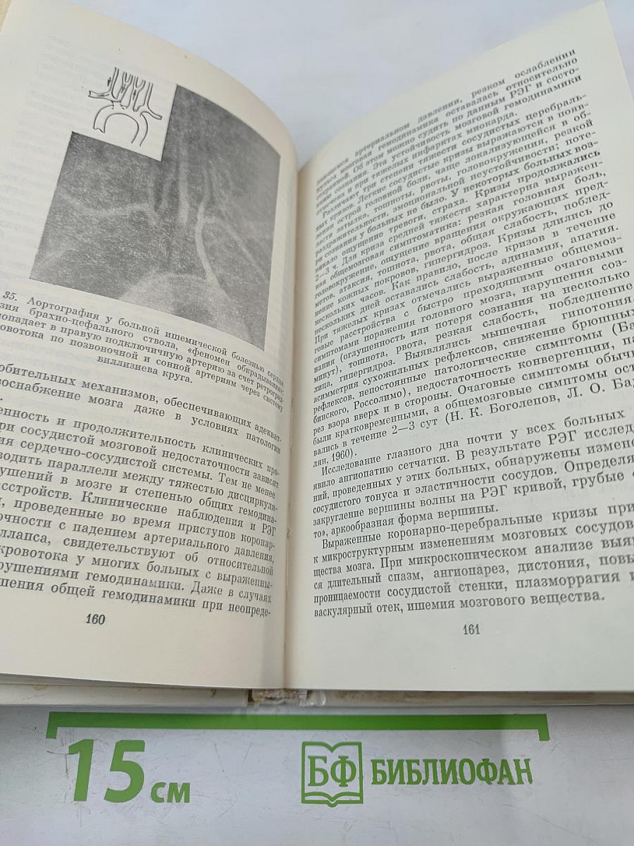 Неврологические синдромы при болезнях сердца