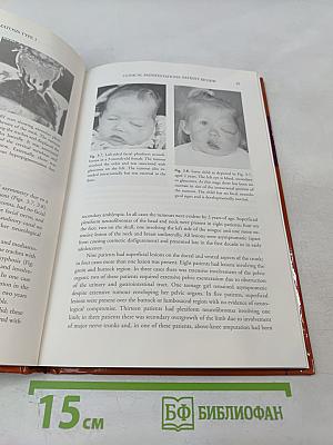 Neurofibromatosis Type 1 in Childhood