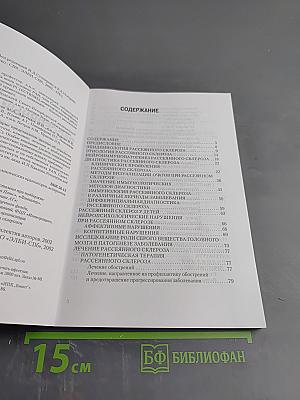 Рассеянный склероз