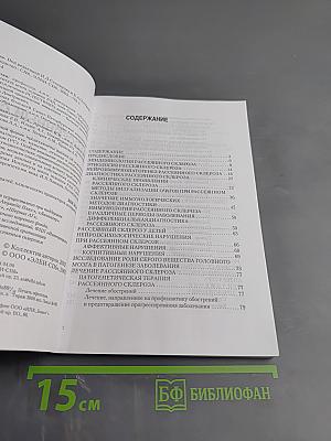 Рассеянный склероз