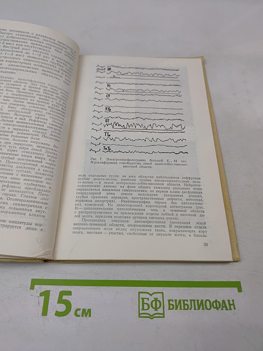 Джексоновский припадок