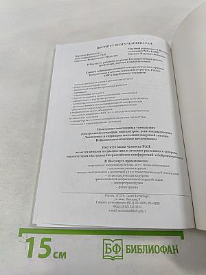 Рассеянный склероз