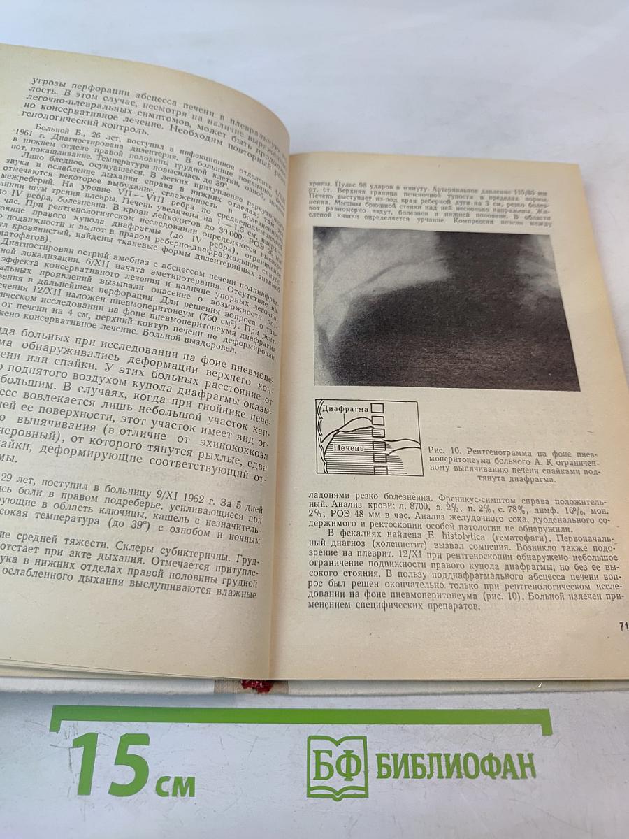 Амебный абсцесс печени