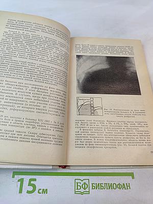 Амебный абсцесс печени