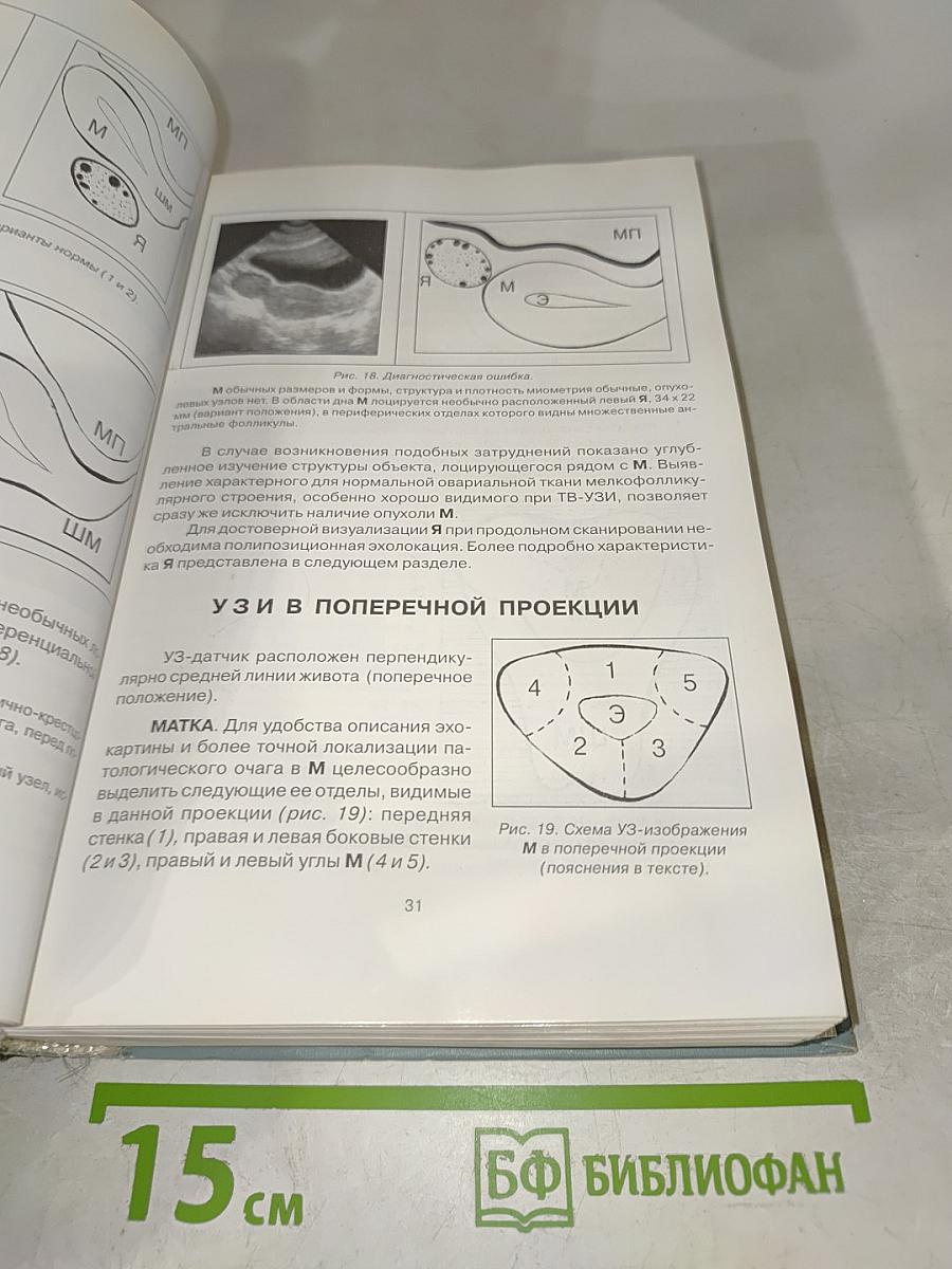 УЗИ в гинекологии. Симптоматика, диагностические трудности и ошибки